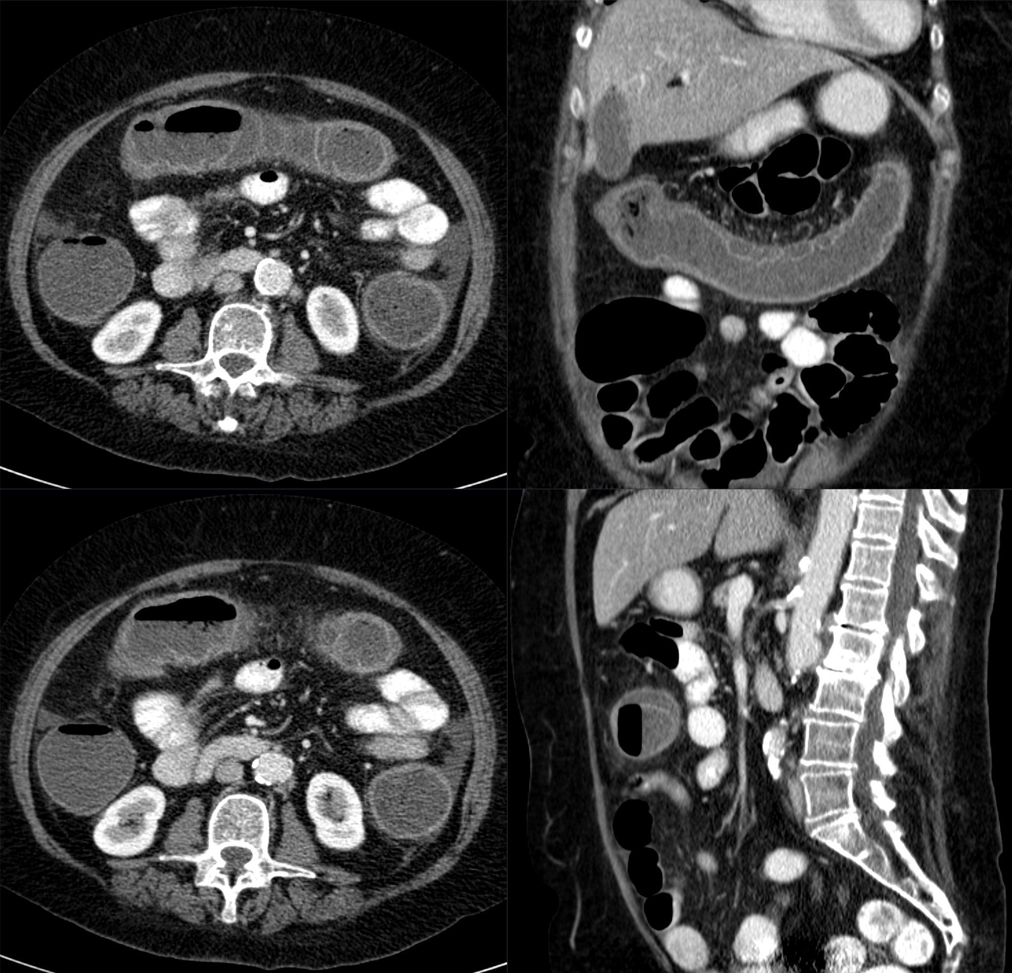 Axial CT showing wall thickening of the transverse colon from colon ischemia.