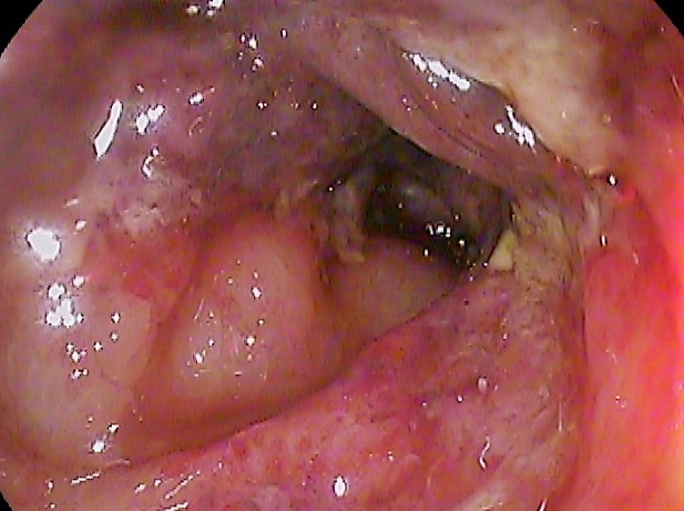 Colonoscopic still of ischemic colitis in the transverse colon: pale, edematous mucosa with exudate in a segmental pattern.