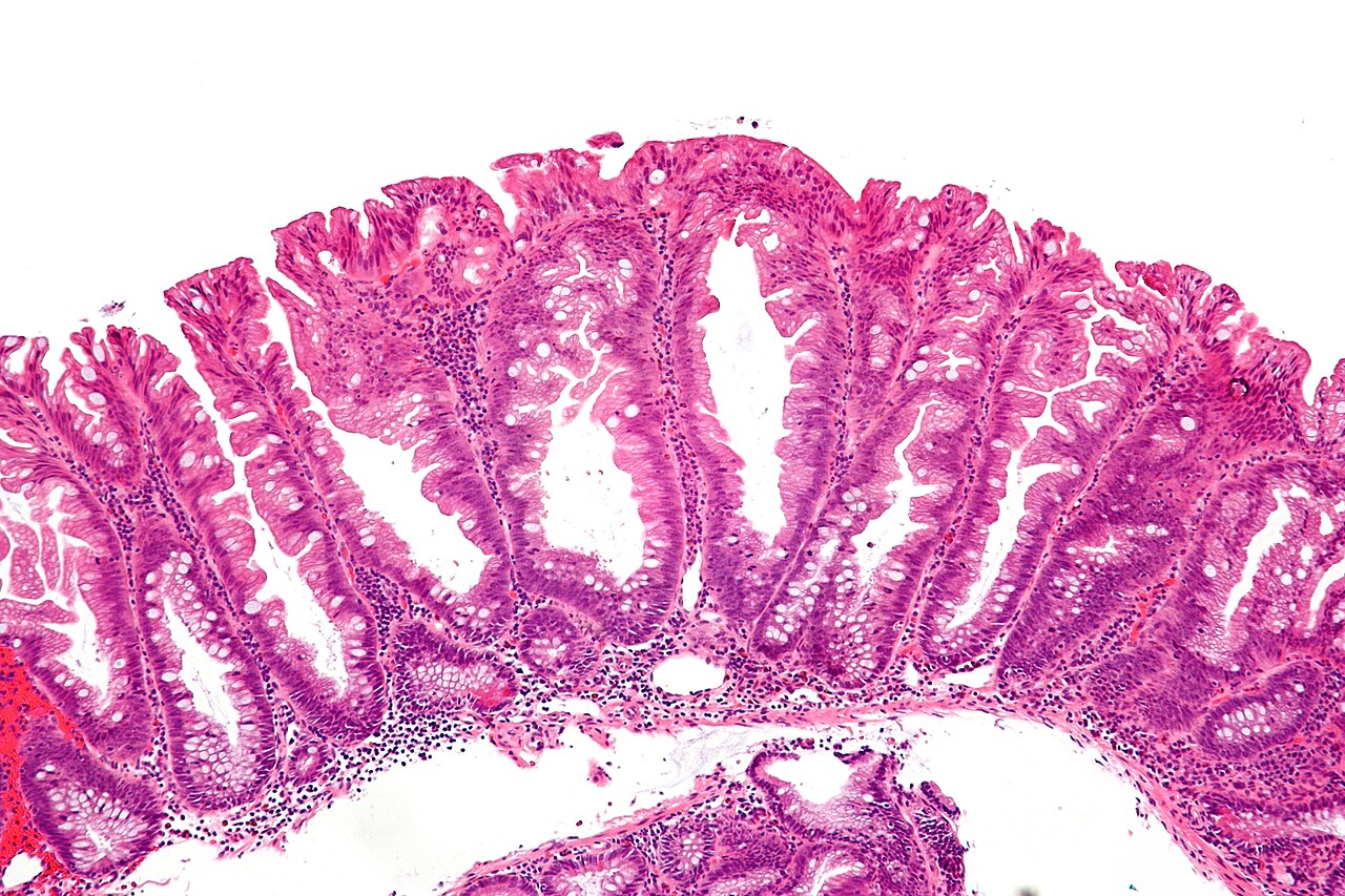H&E micrograph of a cecal sessile serrated lesion with dilated boot-shaped crypt bases.