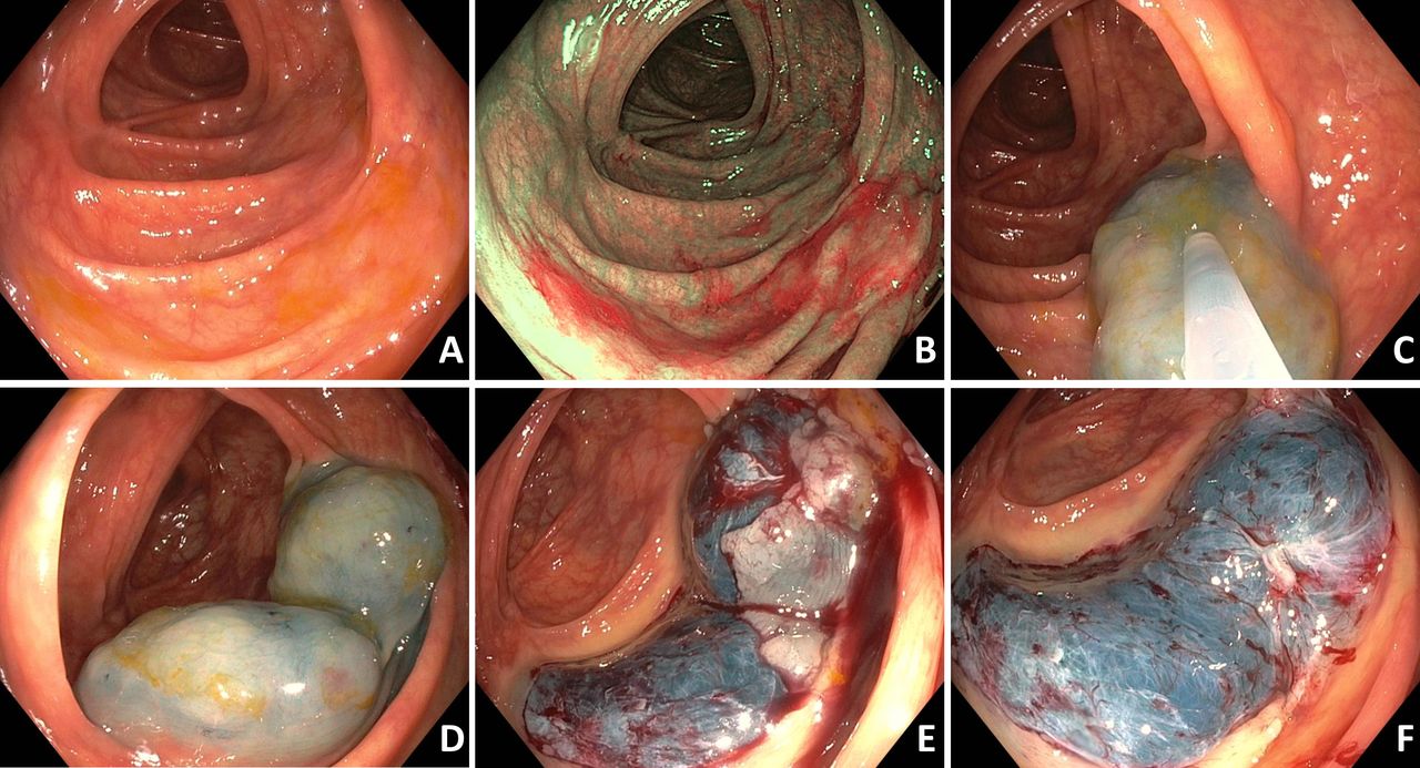 Tips for Effective Cold Snare Polypectomy – Because Hot Snare Isn’t Always the Hero